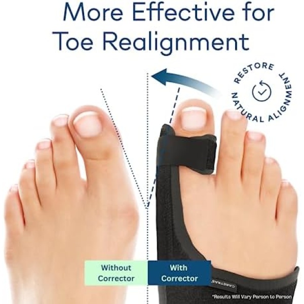 Caretras Bunion Corrector, Orthopedic Bunion Splint, Big Toe Separator Pain - Image 2